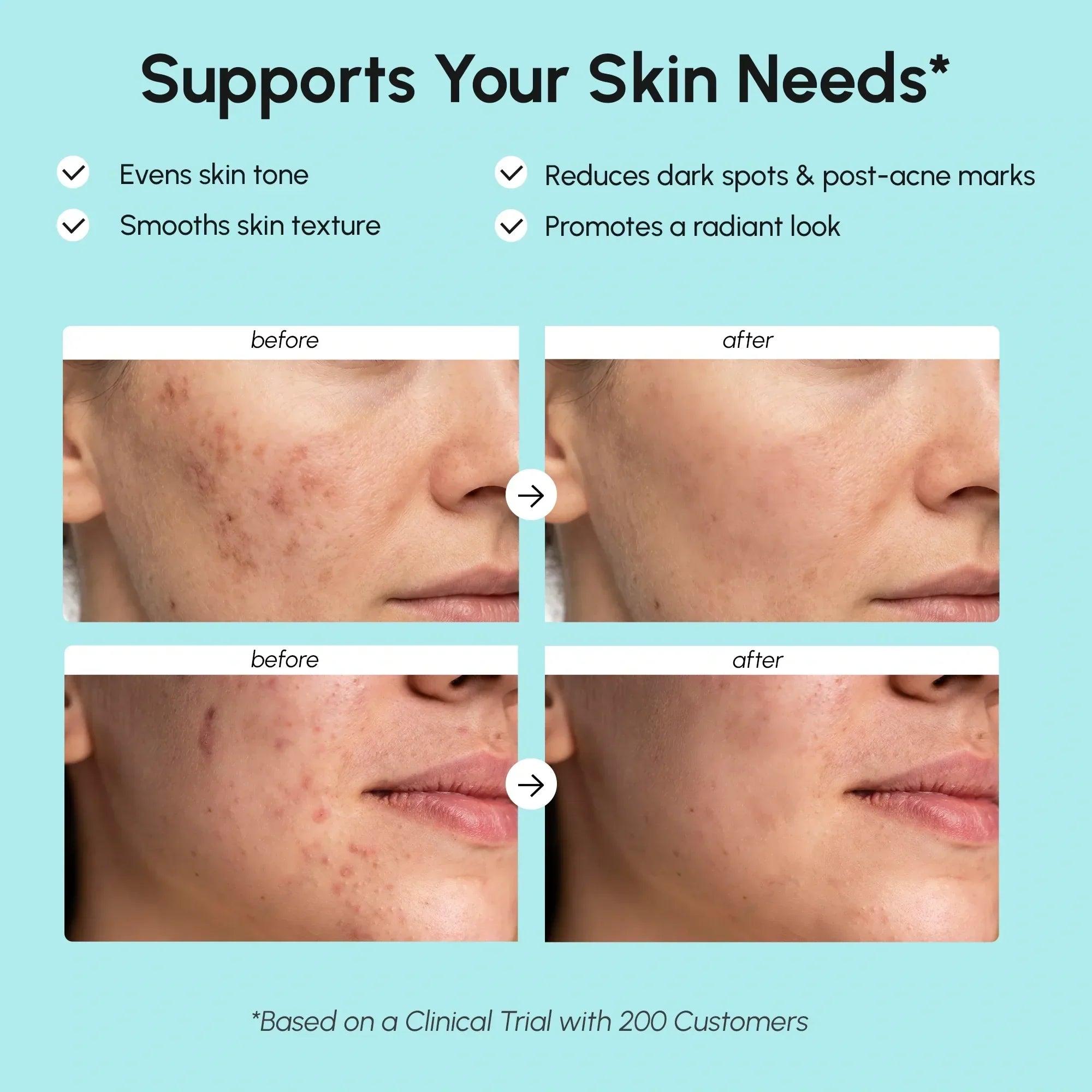 Gentle Azelaic Cream